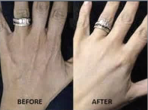 Botox-injected fingers