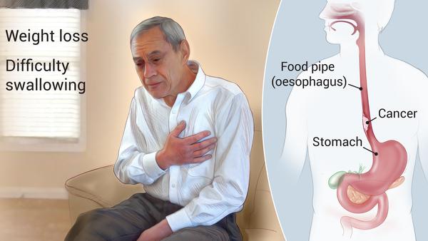 oesophageal cancer