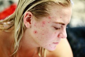How to Prevent And Get Rid of Acne Scars-Using Medical Treatment