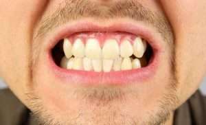 Man smiling widely showin gteeth, Teeth