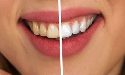 Maintain Smile After Teeth Whitening